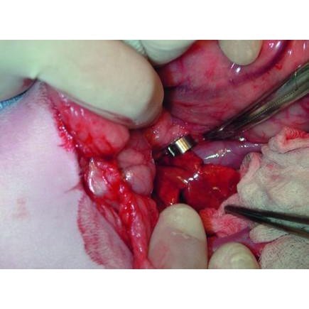 Ameroid Constrictors - Surgical SystemsGBP General