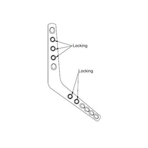 Elbow Arthrodesis Plate 3.5mm/2.7mm - Surgical SystemsArthrodesis