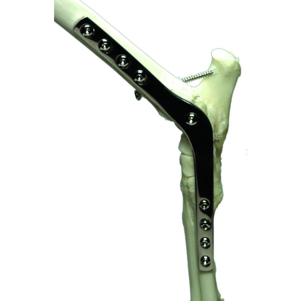 Pantarsal Arthrodesis Plate - Surgical SystemsArthrodesis