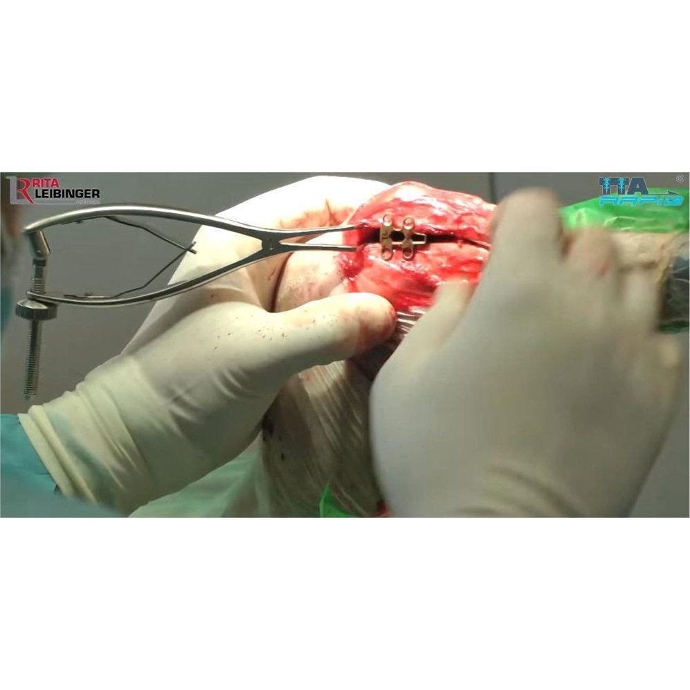 TTA Rapid Spreader - Surgical SystemsRapid Luxation Rita