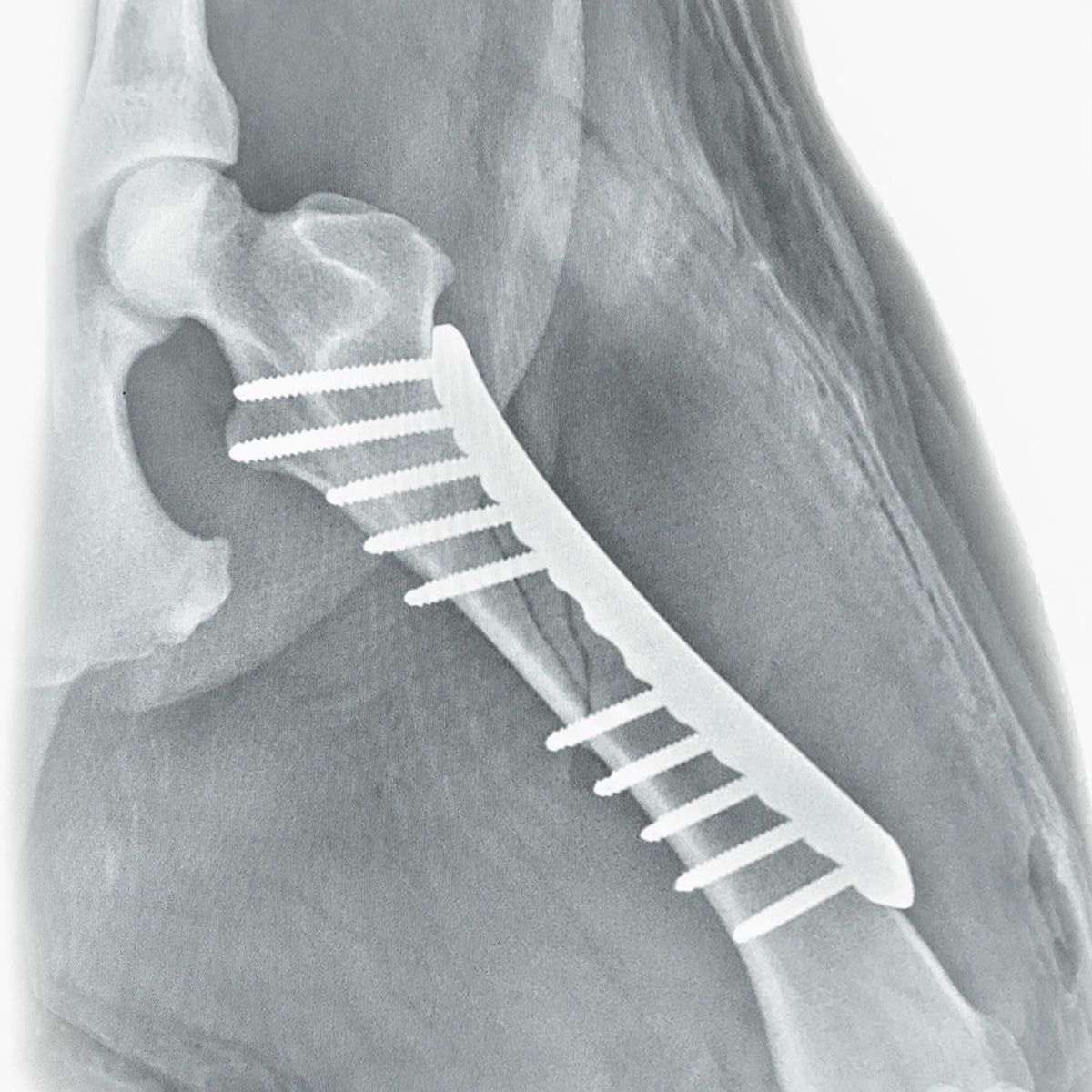 Bone Plates – Bone Compression Plates – Surgical Systems