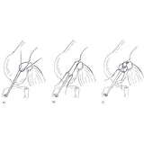 CCL Lateral Nylon Sutures Double - no Crimp - Surgical SystemsCCL Kits & Crimps