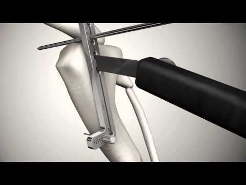 Microlocking Video 1.5 LeiLOX Starter MicroLocking Set – Surgical Systems